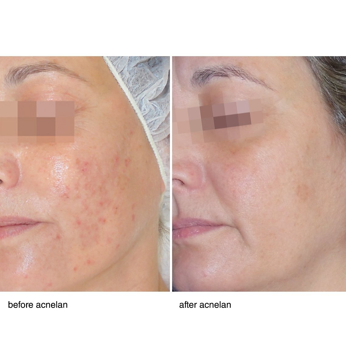 Acnelan Peeling Treatment for Acne prone skin